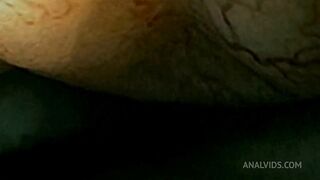 looped anal trip in hemorrhoid filled asshole - vore endoscopy video with heartbeat